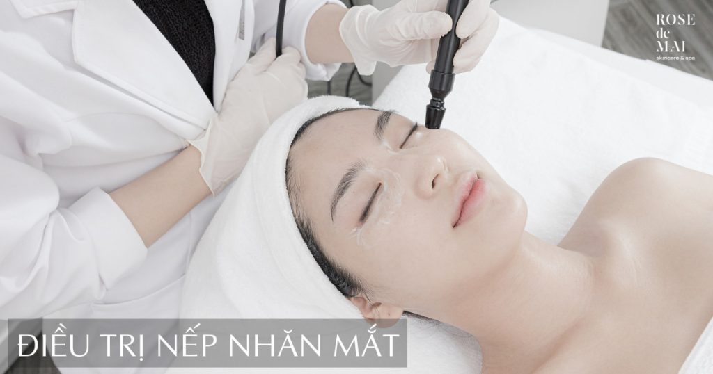Điều trị nếp nhăn mắt
