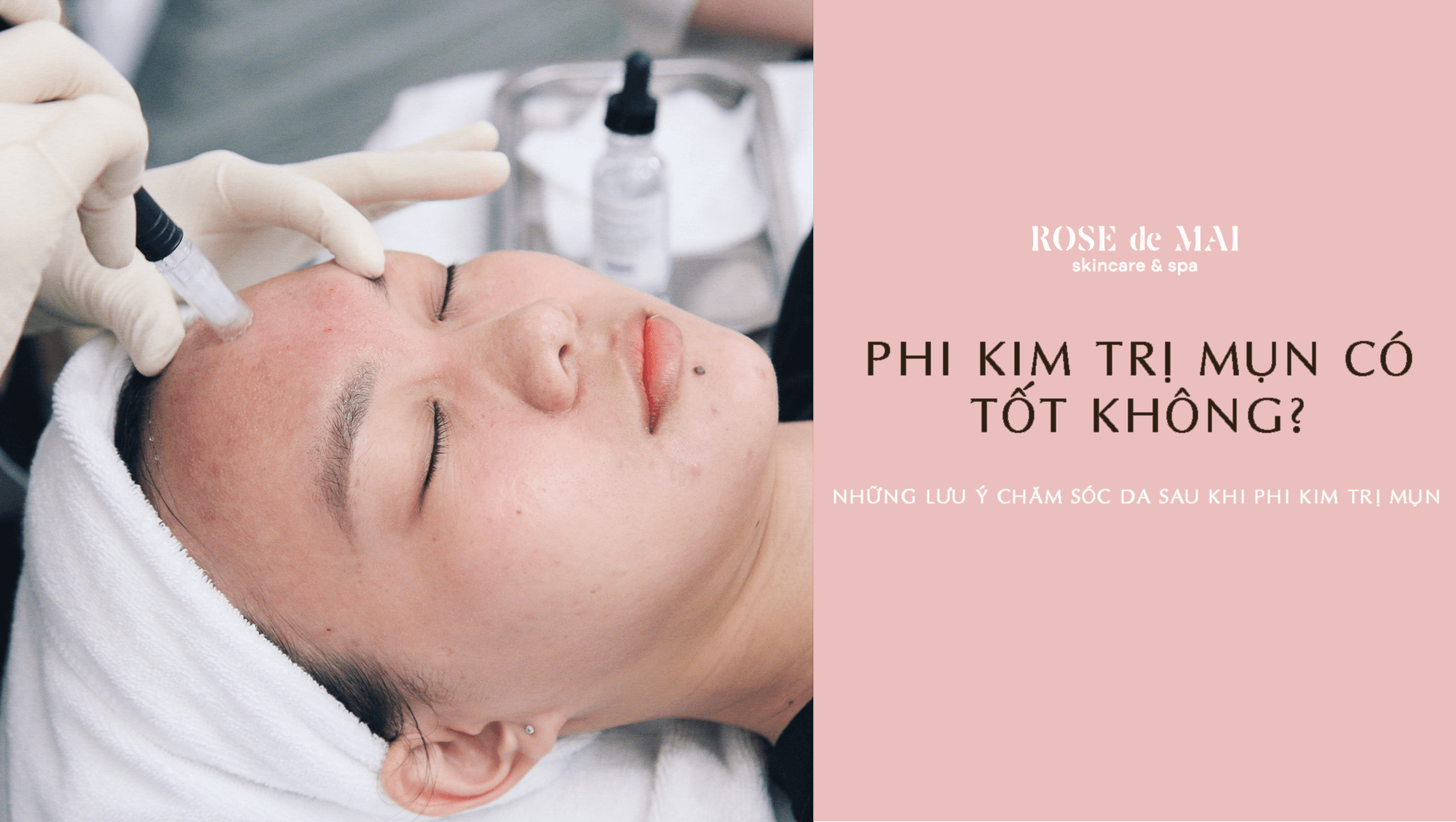 Phi kim trị mụn ngày càng được ứng dụng nhiều hơn vì hiệu quả cao mà nó mang lại, giải quyết được hầu hết những khuyết điểm của làn da mụn.