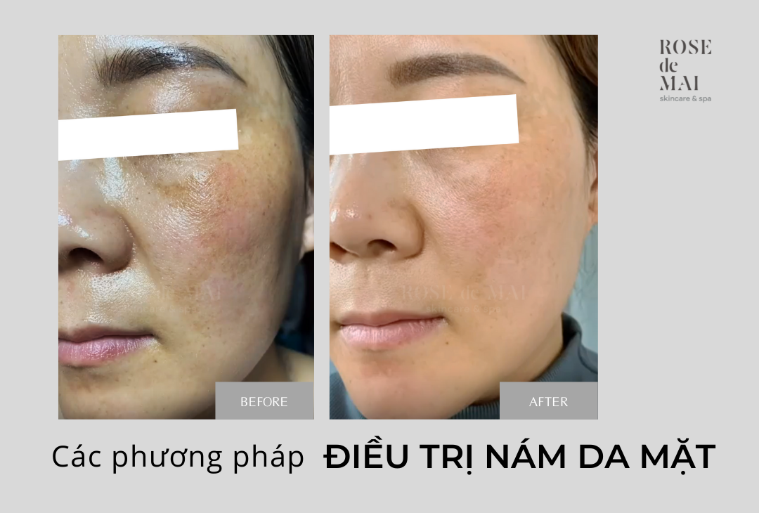 Điều trị nám da mặt