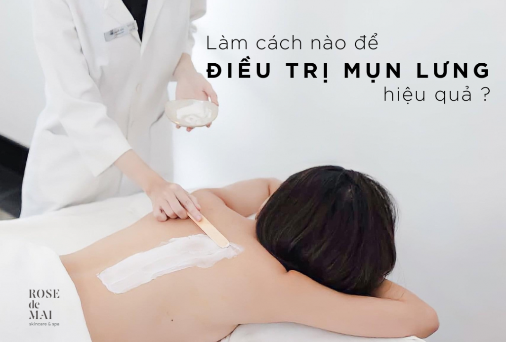 Điều trị mụn lưng