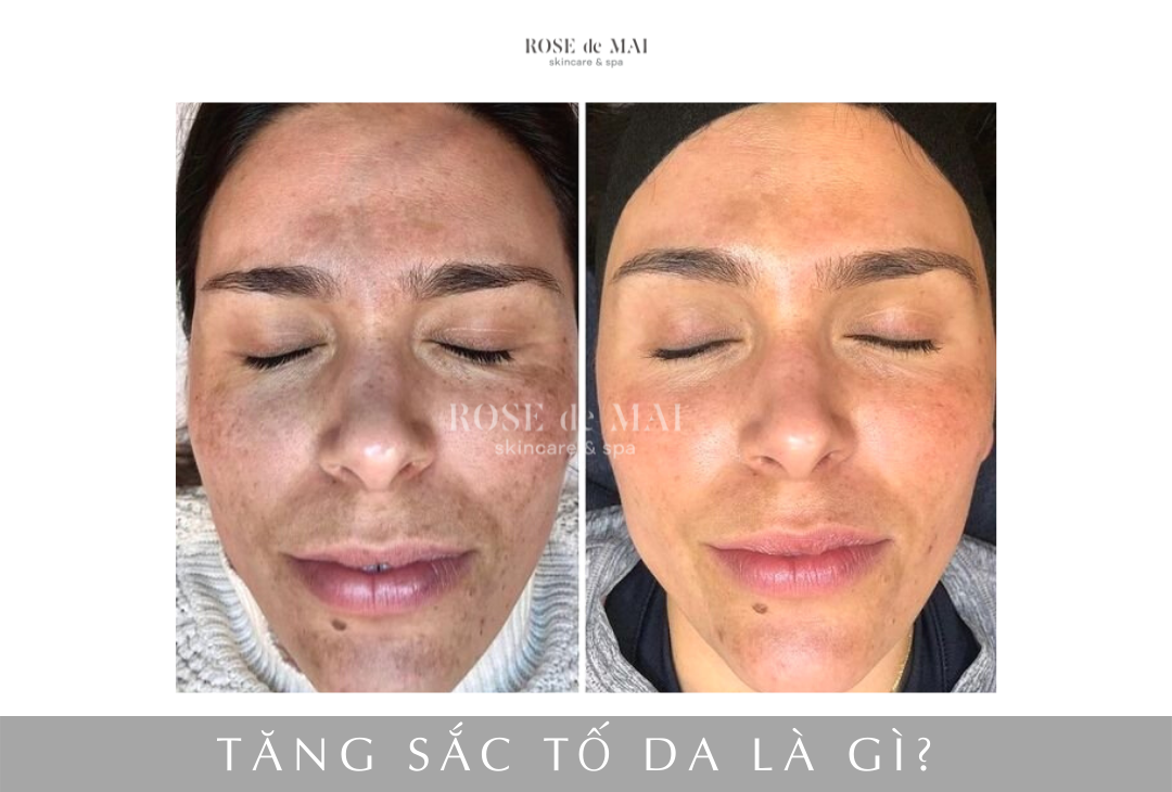 Da có dấu hiệu lão hóa, tăng sắc tố da.