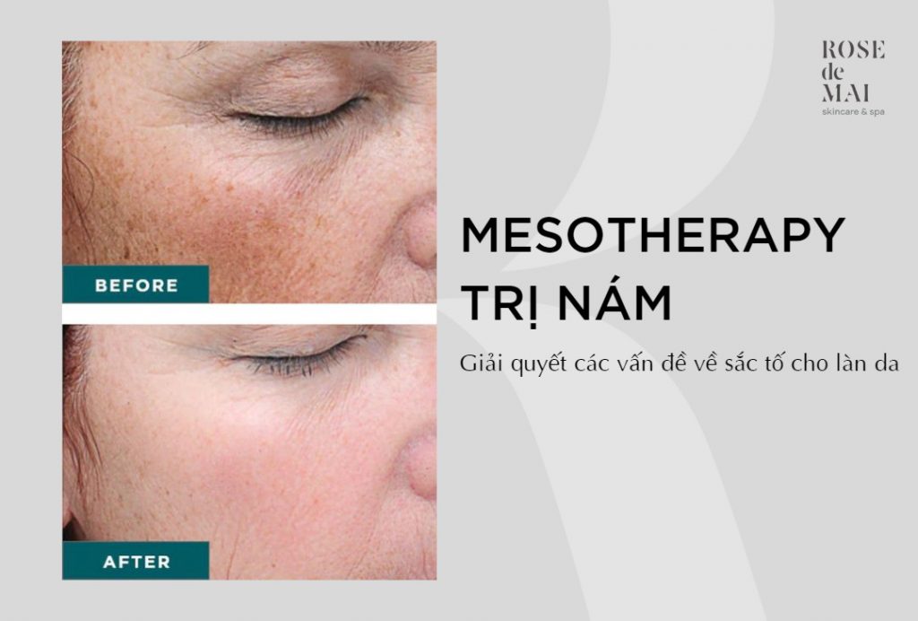 Mesotherapy trị nám - Giải quyết các vấn đề về sắc tố cho làn da