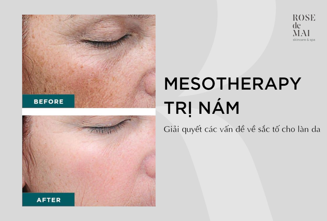 Mesotherapy trị nám - Giải quyết các vấn đề về sắc tố cho làn da