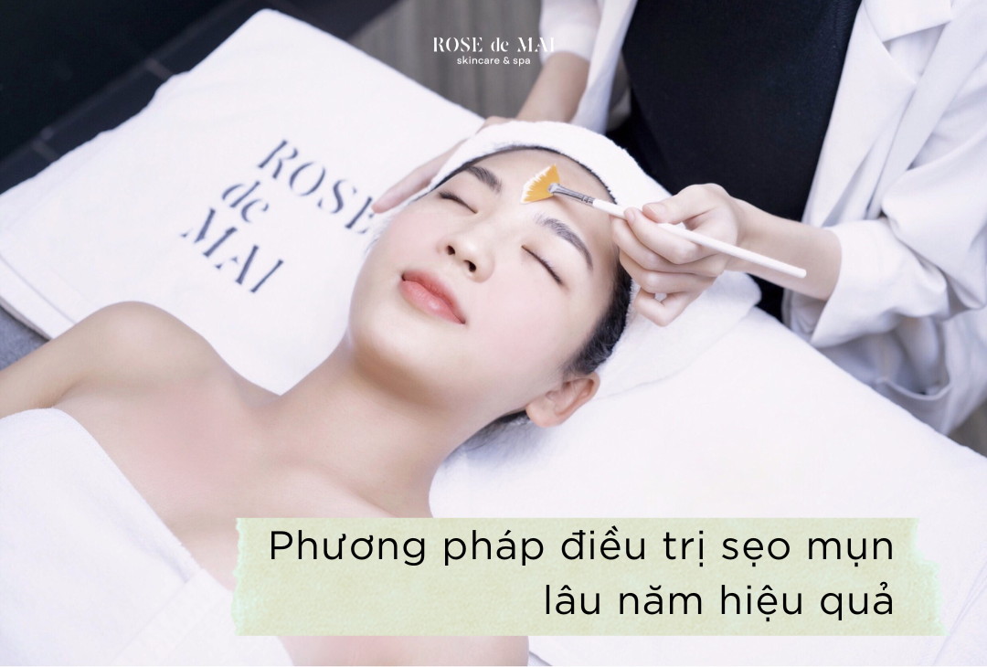Phương pháp điều trị sẹo mụn lâu năm hiệu quả